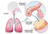 Nguyên nhân, cách nhận biết và phòng bệnh phổi tắc nghẽn mạn tính