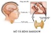 Bệnh Basedow và những điều cần biết