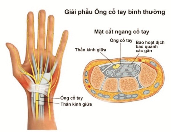 hội chứng cáy tay cổ